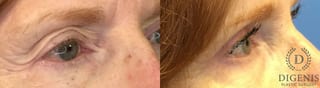 Before and after Eye Lid Surgery case 35153 - Angle 2