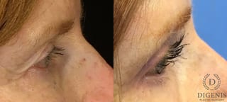 Before and after Eye Lid Surgery case 35153 - Angle 3