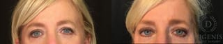 Before and after Eye Lid Surgery case 35154 - Angle 1