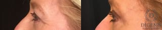 Before and after Eye Lid Surgery case 35154 - Angle 5