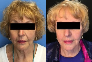Before and after Digenis Refresh Lift case 35155 - Angle 1