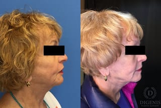 Before and after Digenis Refresh Lift case 35155 - Angle 3