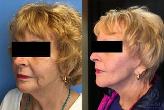 Before and after Digenis Refresh Lift case 35155 - Angle 4