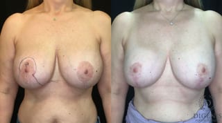 Before and after Breast Lift with or without Implants case 35156 - Angle 1