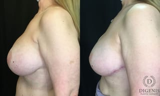 Before and after Breast Lift with or without Implants case 35156 - Angle 5