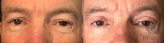 Before and after Eye Lid Surgery case 35158 - Angle 1