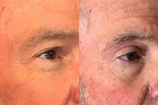 Before and after Eye Lid Surgery case 35158 - Angle 2