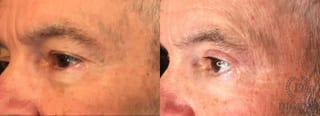 Before and after Eye Lid Surgery case 35158 - Angle 4