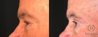 Before and after Eye Lid Surgery case 35158 - Angle 5