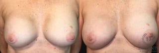 Before and after Breast Implant Exchange or Removal case 35159 - Angle 1