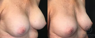 Before and after Breast Implant Exchange or Removal case 35159 - Angle 2