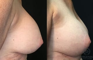 Before and after Breast Implant Exchange or Removal case 35159 - Angle 3