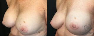 Before and after Breast Implant Exchange or Removal case 35159 - Angle 4