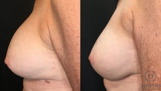 Before and after Breast Implant Exchange or Removal case 35159 - Angle 5