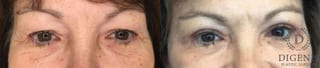 Before and after Eye Lid Surgery case 35160 - Angle 1