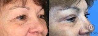 Before and after Eye Lid Surgery case 35160 - Angle 2