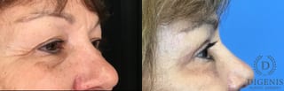 Before and after Eye Lid Surgery case 35160 - Angle 3