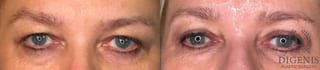 Before and after Eye Lid Surgery case 35161 - Angle 1