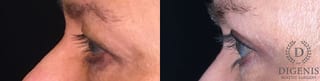 Before and after Eye Lid Surgery case 35161 - Angle 3