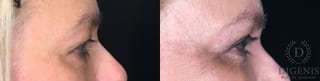 Before and after Eye Lid Surgery case 35161 - Angle 5