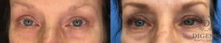 Before and after Eye Lid Surgery case 35163 - Angle 1
