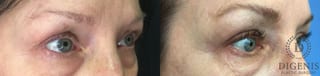 Before and after Eye Lid Surgery case 35163 - Angle 2