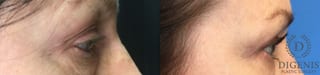 Before and after Eye Lid Surgery case 35163 - Angle 3