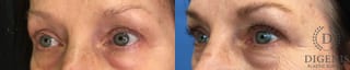 Before and after Eye Lid Surgery case 35163 - Angle 4
