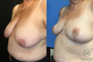 Before and after Breast Reduction case 35164 - Angle 4
