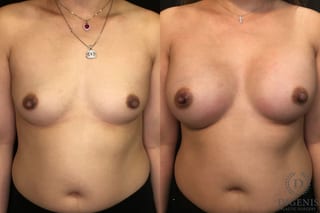 Before and after Breast Augmentation case 35165 - Angle 1
