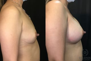 Before and after Breast Augmentation case 35165 - Angle 3