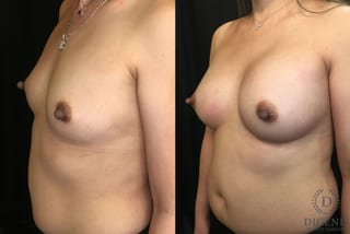 Before and after Breast Augmentation case 35165 - Angle 4