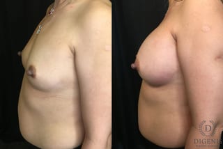 Before and after Breast Augmentation case 35165 - Angle 5