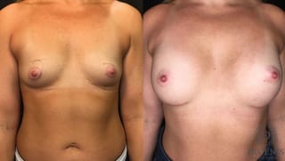 Before and after Breast Augmentation case 35166 - Angle 1