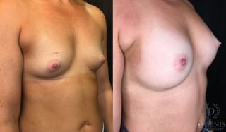 Before and after Breast Augmentation case 35166 - Angle 2