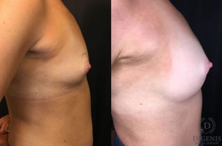 Before and after Breast Augmentation case 35166 - Angle 3