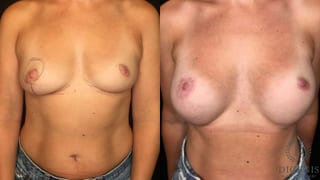Before and after Breast Lift with or without Implants case 35168 - Angle 1