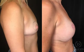 Before and after Breast Lift with or without Implants case 35168 - Angle 3