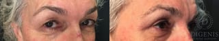 Before and after Eye Lid Surgery case 35171 - Angle 2