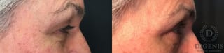 Before and after Eye Lid Surgery case 35171 - Angle 3