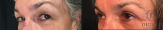 Before and after Eye Lid Surgery case 35171 - Angle 4