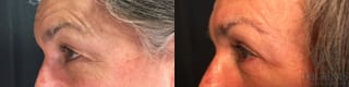 Before and after Eye Lid Surgery case 35171 - Angle 5
