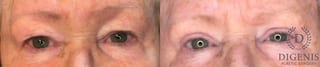 Before and after Eye Lid Surgery case 35170 - Angle 1