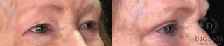 Before and after Eye Lid Surgery case 35170 - Angle 2