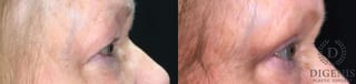 Before and after Eye Lid Surgery case 35170 - Angle 3
