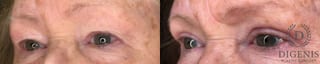 Before and after Eye Lid Surgery case 35170 - Angle 4