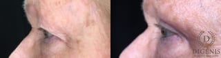 Before and after Eye Lid Surgery case 35170 - Angle 5