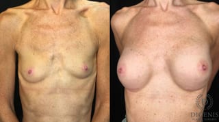 Before and after Breast Augmentation case 35172 - Angle 1
