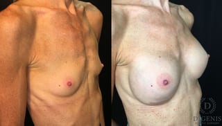 Before and after Breast Augmentation case 35172 - Angle 2
