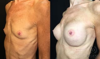 Before and after Breast Augmentation case 35172 - Angle 4